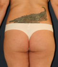 Feel Beautiful - Liposuction Waist-Flanks-Upper Inner Thighs 214 - Before Photo